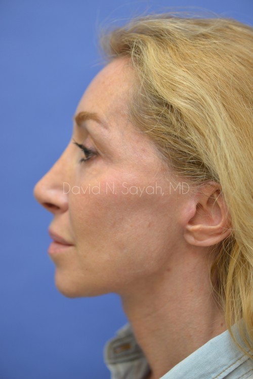 Facelift Before and After | Sayah Institute