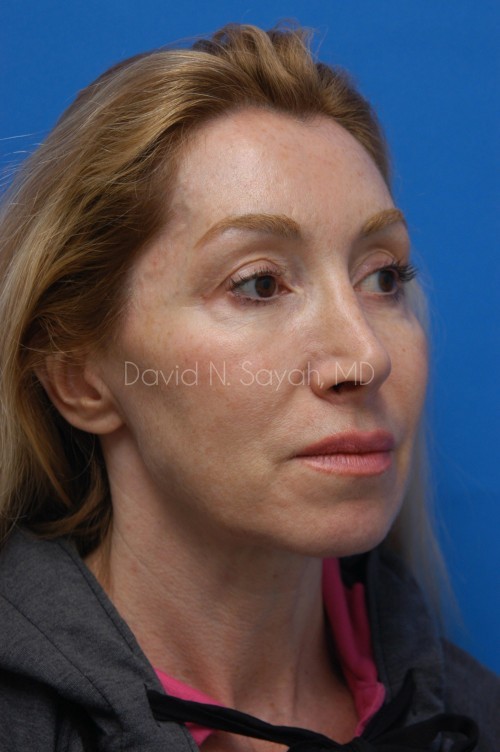 Facelift Before and After | Sayah Institute