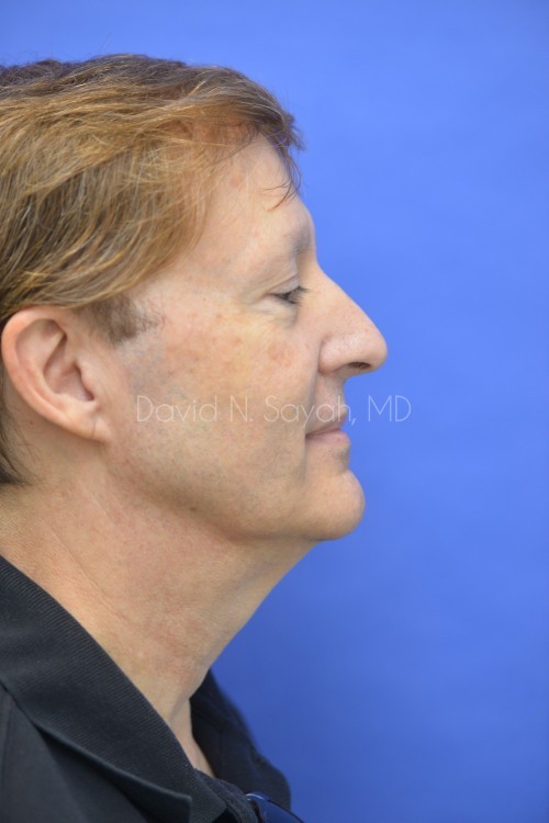 Facelift Before and After | Sayah Institute