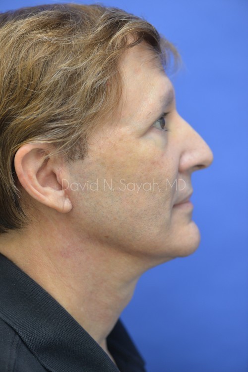 Facelift Before and After | Sayah Institute
