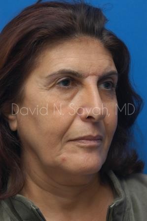 Facelift Before and After | Sayah Institute
