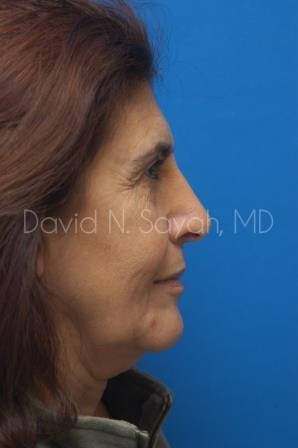 Facelift Before and After | Sayah Institute
