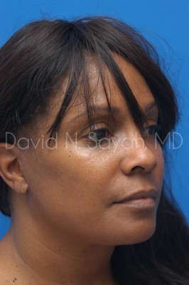 Facelift Before and After | Sayah Institute