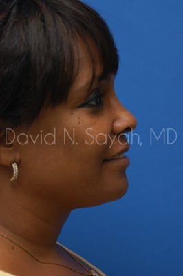 Facelift Before and After | Sayah Institute