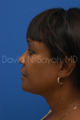 Facelift Before and After | Sayah Institute