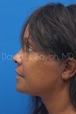 Facelift Before and After | Sayah Institute