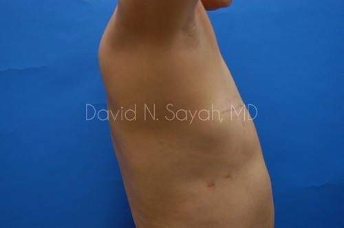 Fat Injection Breast Before and After | Sayah Institute