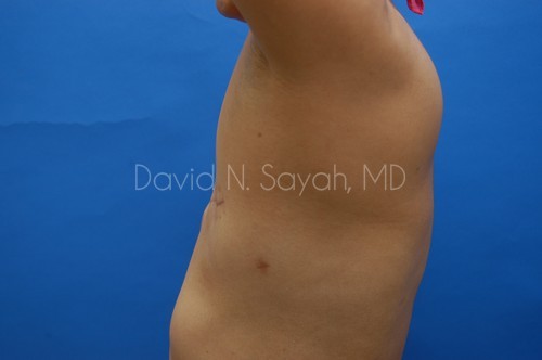 Fat Injection Breast Before and After | Sayah Institute