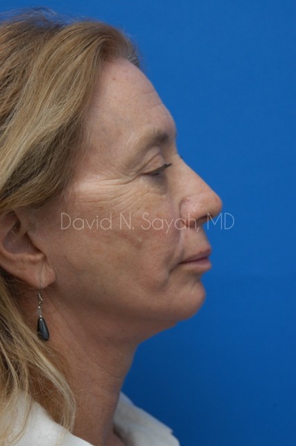 Fat Injection Face Before and After | Sayah Institute