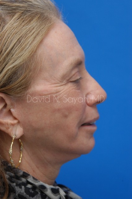 Fat Injection Face Before and After | Sayah Institute