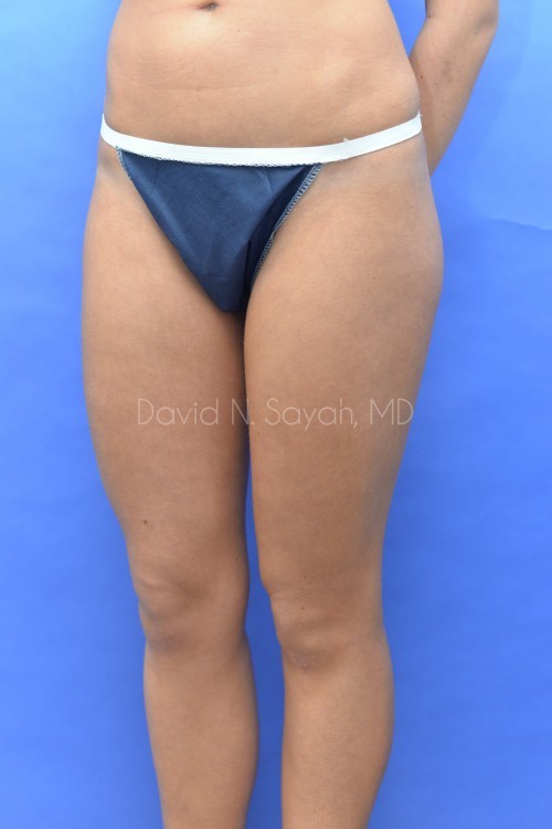 Liposuction Before and After | Sayah Institute
