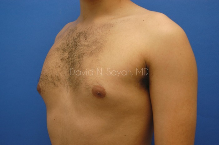 Liposuction Before and After | Sayah Institute