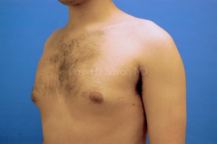 Liposuction Before and After | Sayah Institute