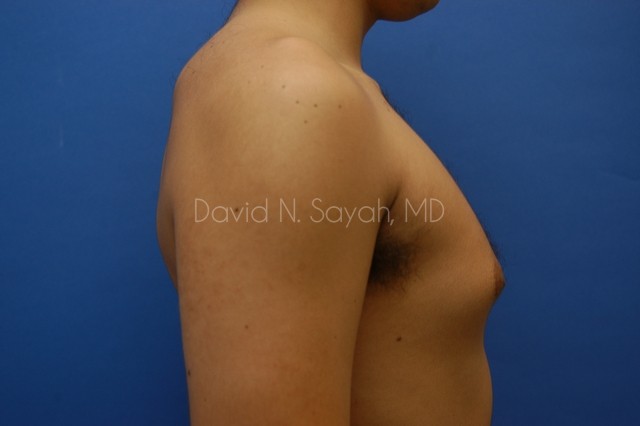 Liposuction Before and After | Sayah Institute