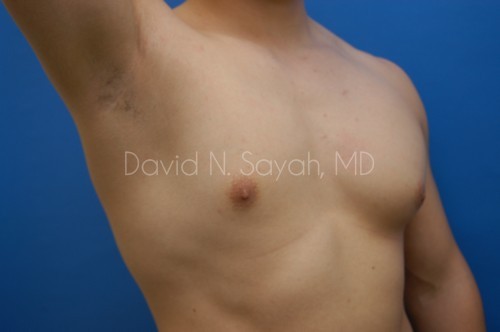 Male Breast Surgery Before and After | Sayah Institute