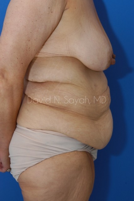 Tummy Tuck Before and After | Sayah Institute